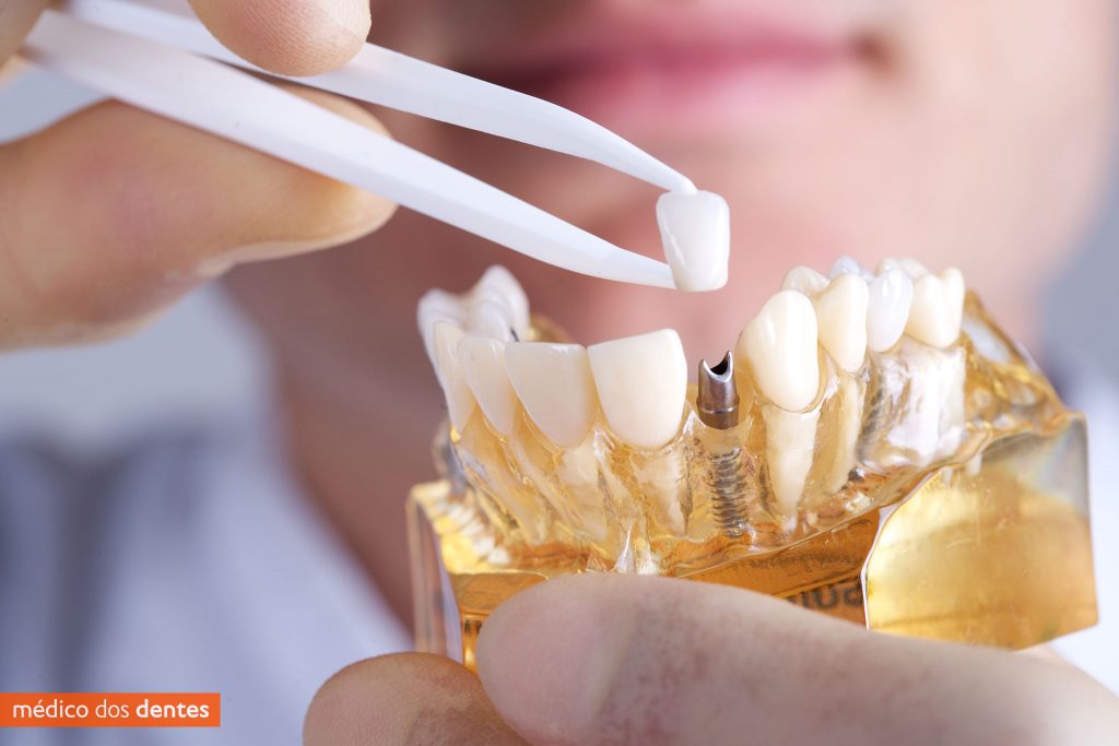 Prótese e implante dentário - Médico dos Dentes