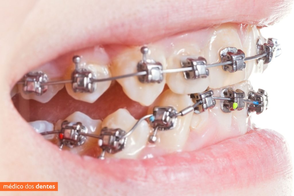 Aparelho dentário autoligável - Médico dos Dentes