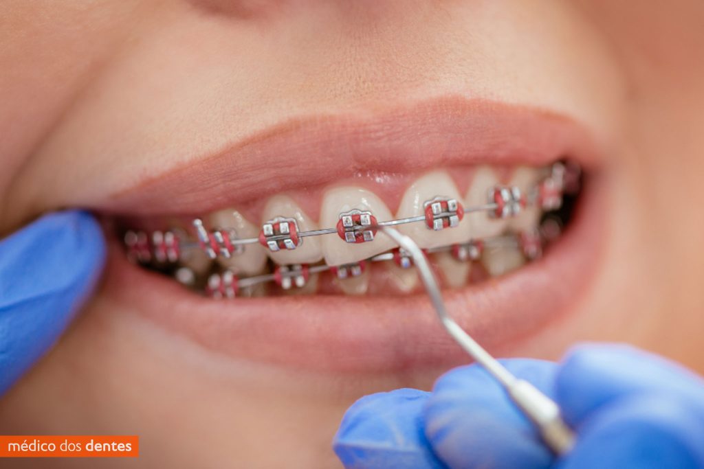Aparelho dentário convencional - Médico dos Dentes
