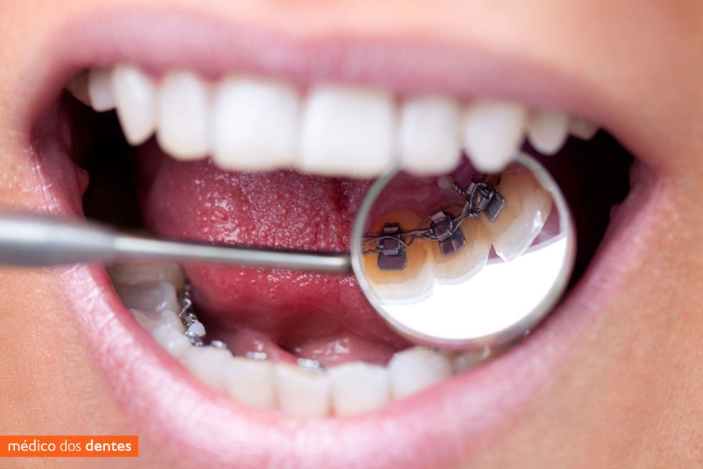 Aparelho dentário lingual - Médico dos dentes