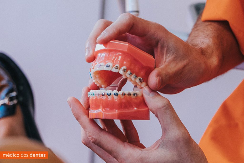 Aparelho dentario - Médico dos Dentes