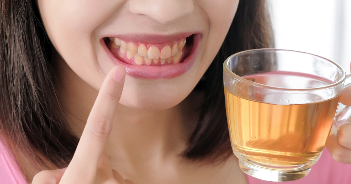 Beber chá escurece os dentes - Médico dos Dentes