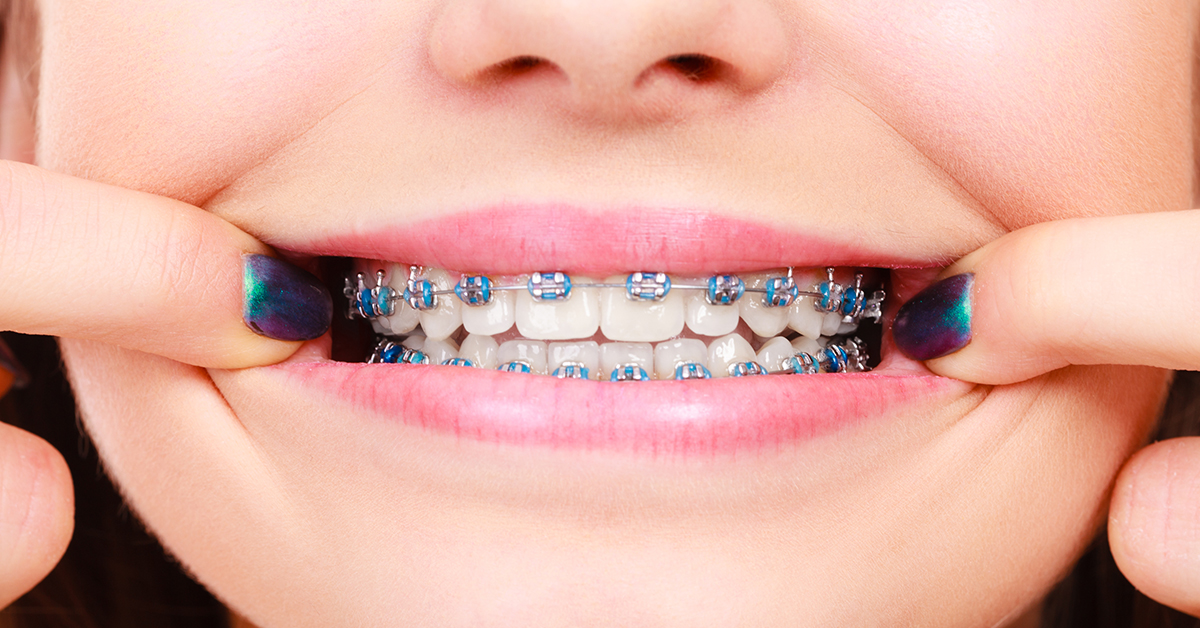 Cuidados a ter com o aparelho dentário fixo - Médico dos Dentes