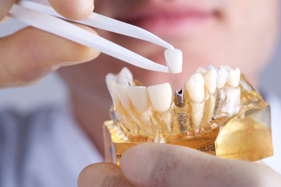 color implantes dentários no dentista - Médico dos Dentes