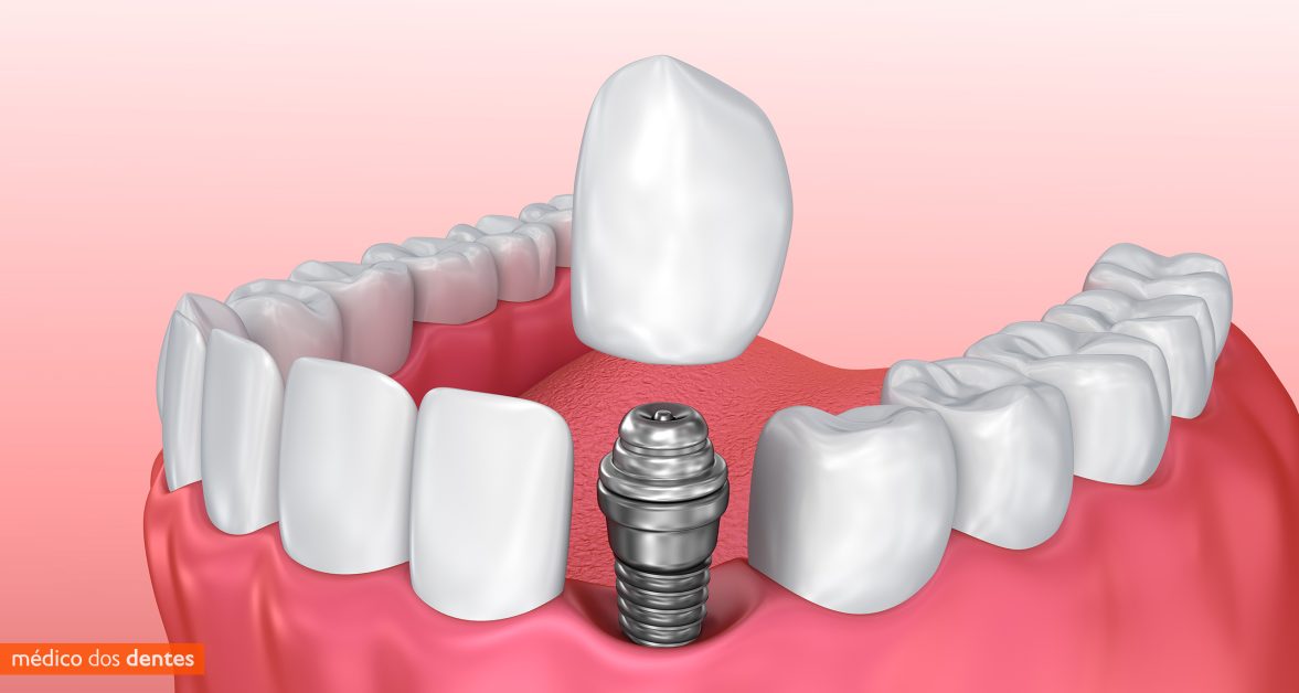 Implantes dentários no Médico dos Dentes