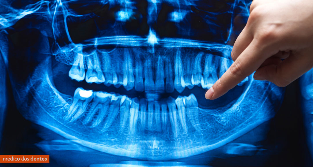 Dentes perdidos - Médico dos Dentes